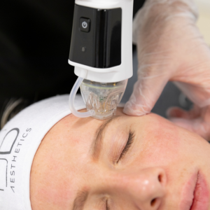 Read more about the article Microneedling in Bradford: A Solution for Uneven Skin Tone and Pigmentation