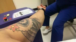 Read more about the article Top Clinics for Laser Tattoo Removal in Coventry